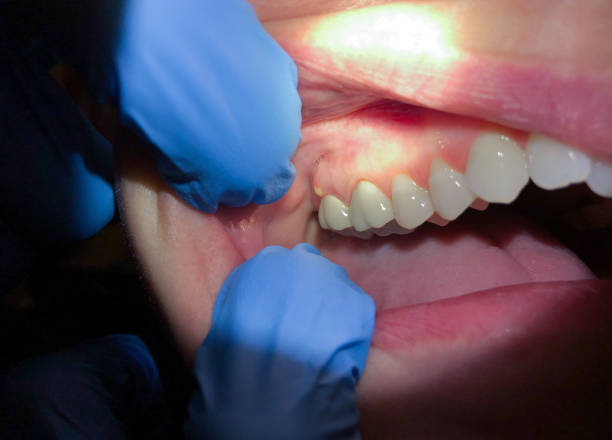 Best Emergency Tooth Extraction in Shinglehouse, PA
